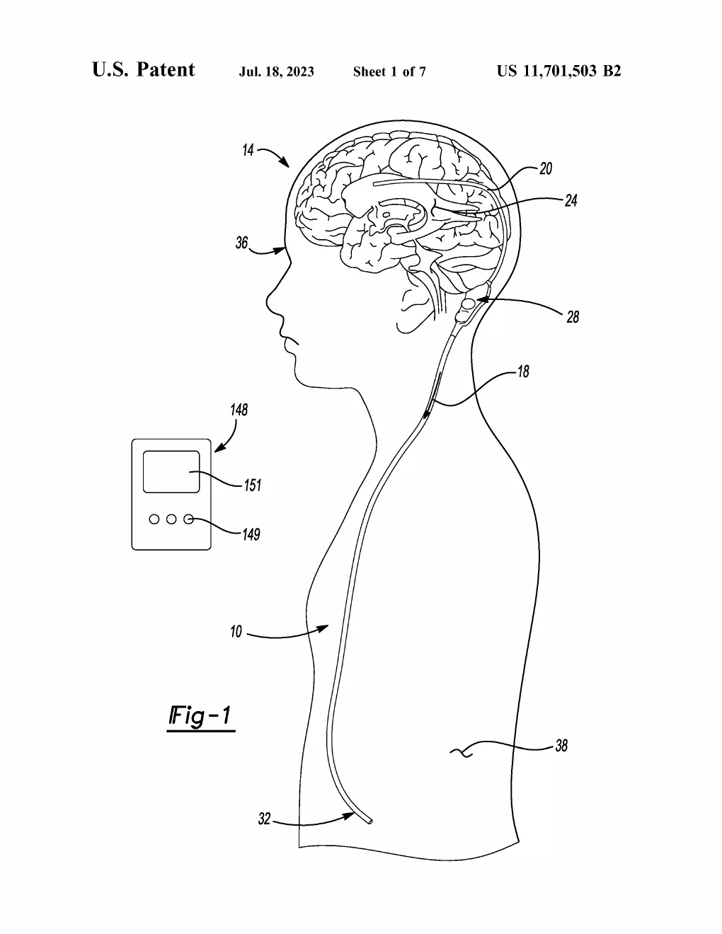Patent drawing, US11701503B2: A side-profile outline of a patient with the full shunt system implanted — a catheter reaching into the brain's fluid space, the valve assembly seated behind the ear, and the drain tube running down inside the torso — with the handheld external programmer drawn alongside.