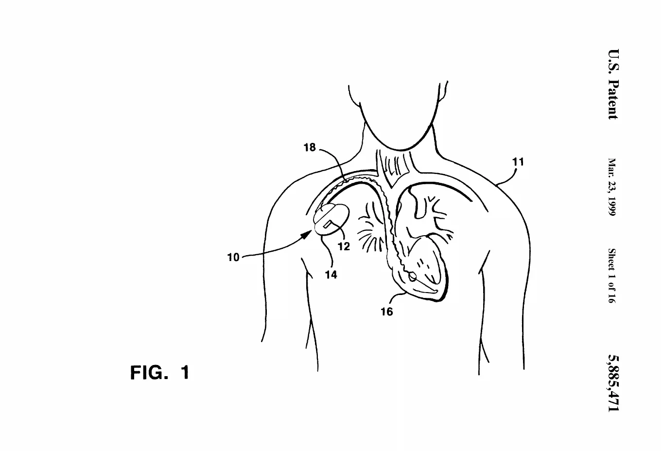 Patent drawing, US5885471A: A cutaway outline of a human torso with the implanted pacemaker in the chest and its lead snaking through a vein into the heart, setting the clinical scene for where the sensor lives.