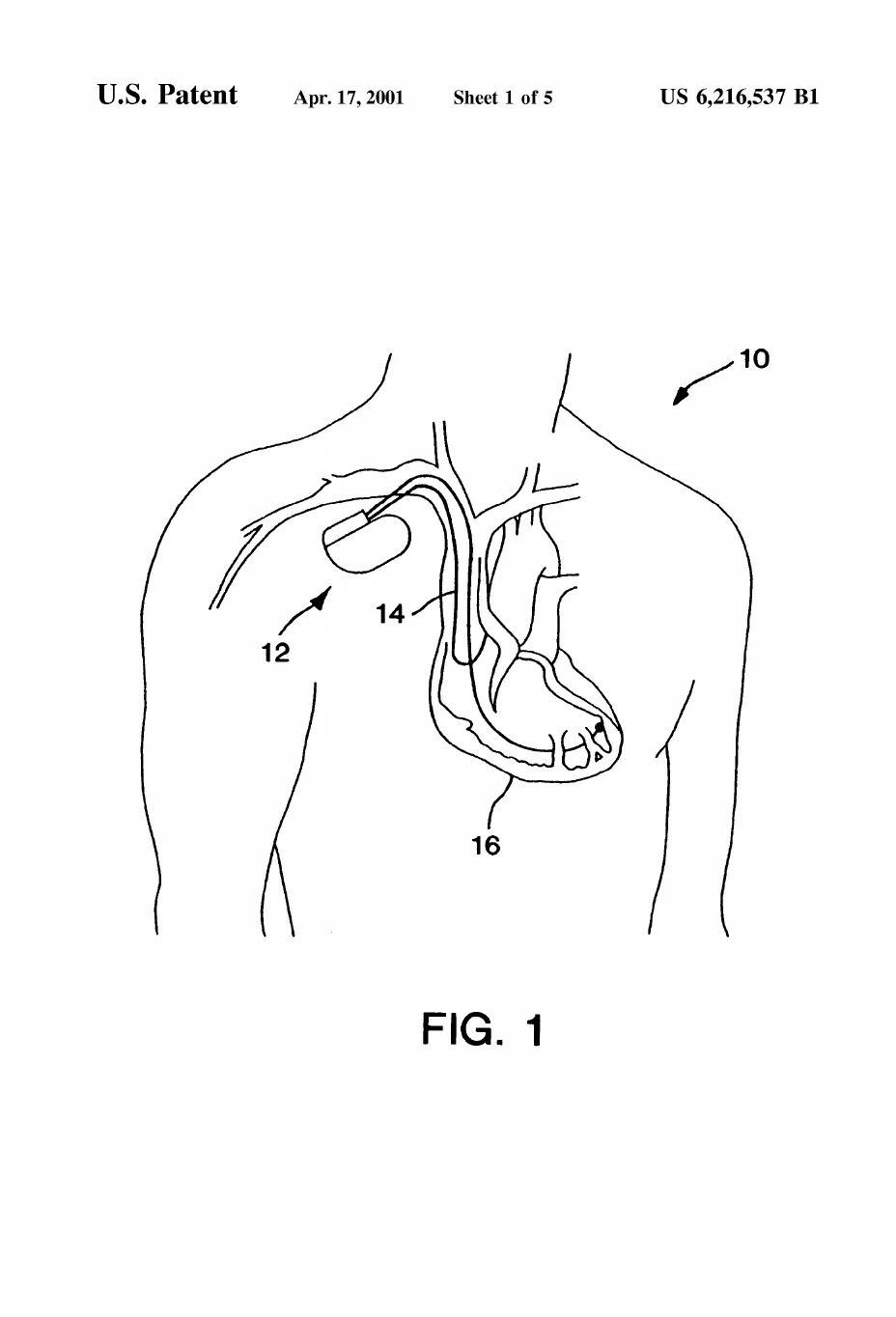 Patent drawing, FIG. 1 of US6216537B1: A human torso outline with the implanted pacemaker under the collarbone and its lead running through a vein into the heart, setting the medical context.