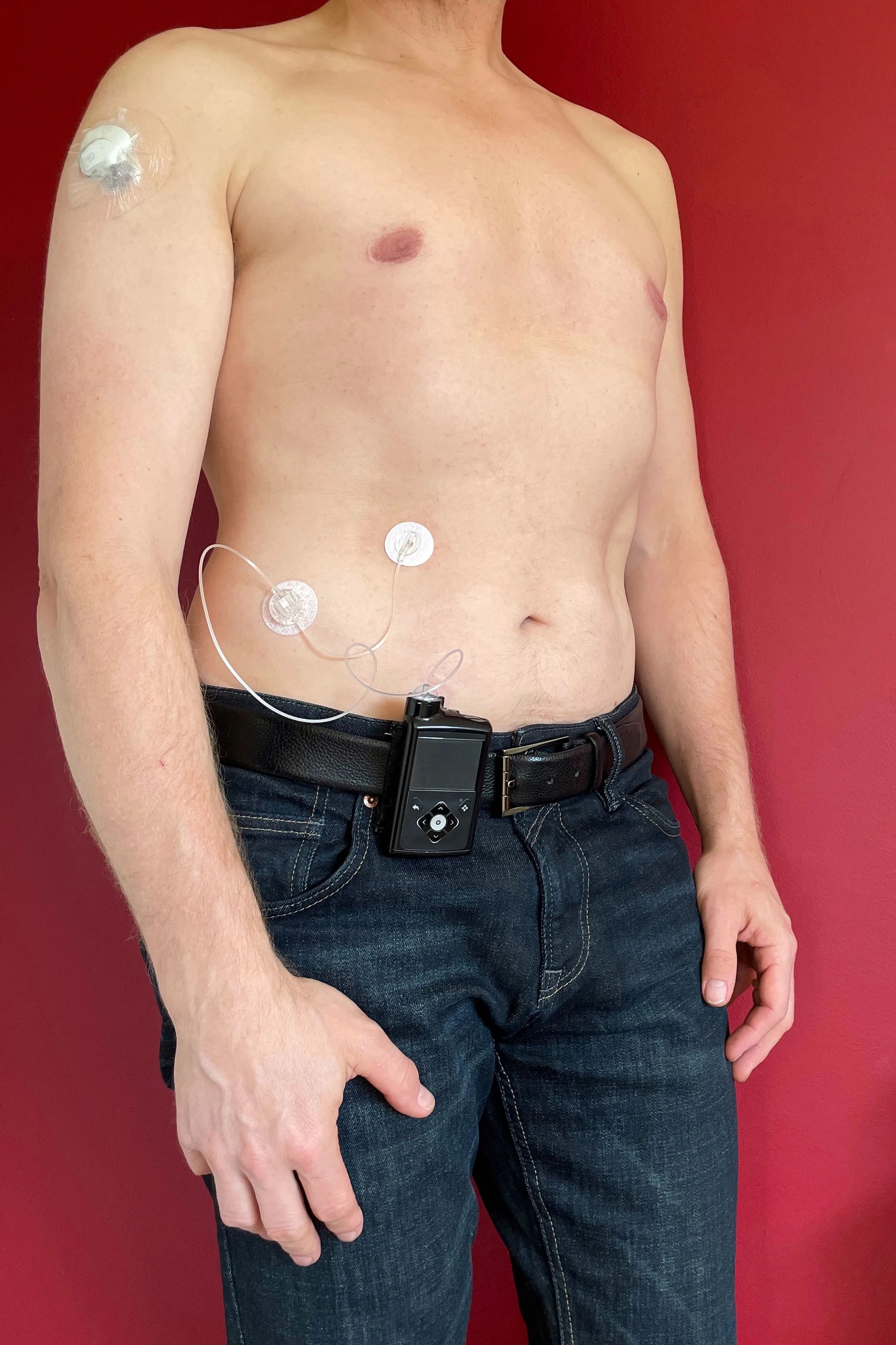 An adult with type 1 diabetes wearing an insulin pump clipped at the waist and a continuous glucose sensor on the skin.