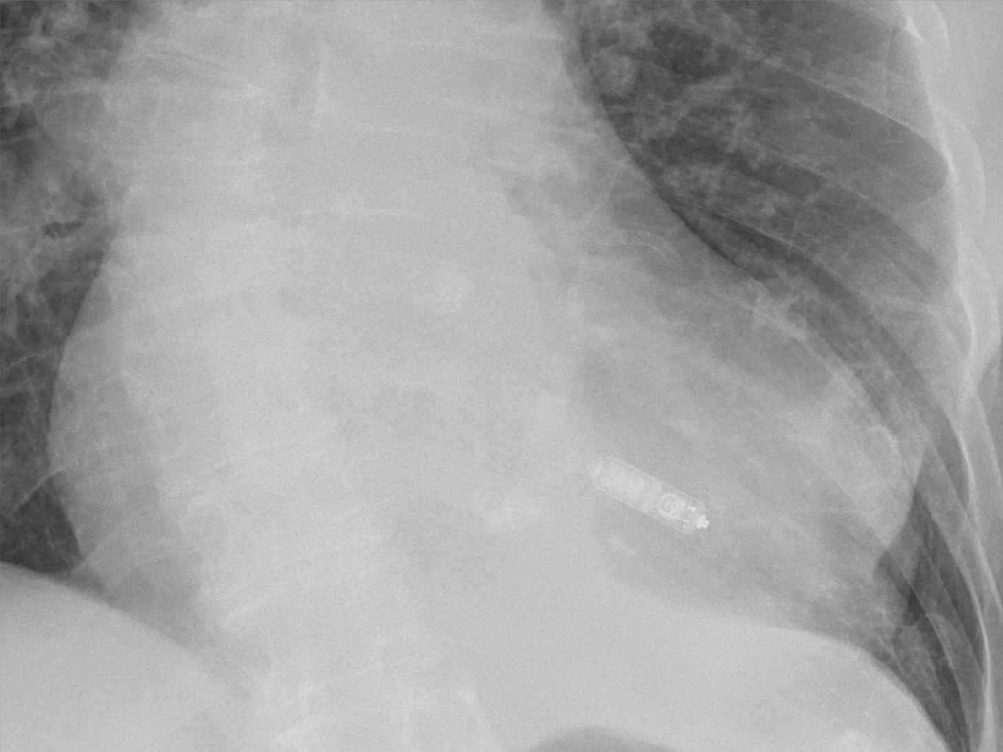 Chest X-ray: the ribcage and heart of an elderly patient, with a tiny Medtronic Micra leadless pacemaker capsule glowing bright inside the heart.